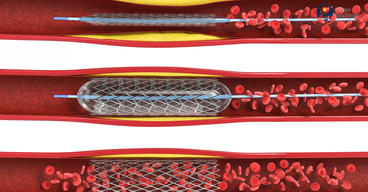 Overview Carotid-Angioplasty