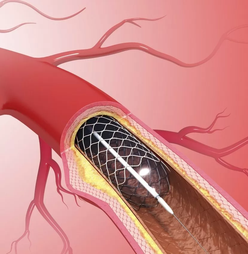 Coronary Angioplasty and Stents in Jaipur