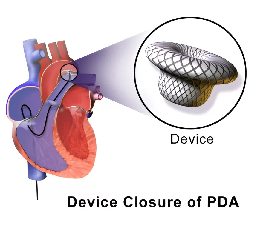 Why is a cardiac closure device used?