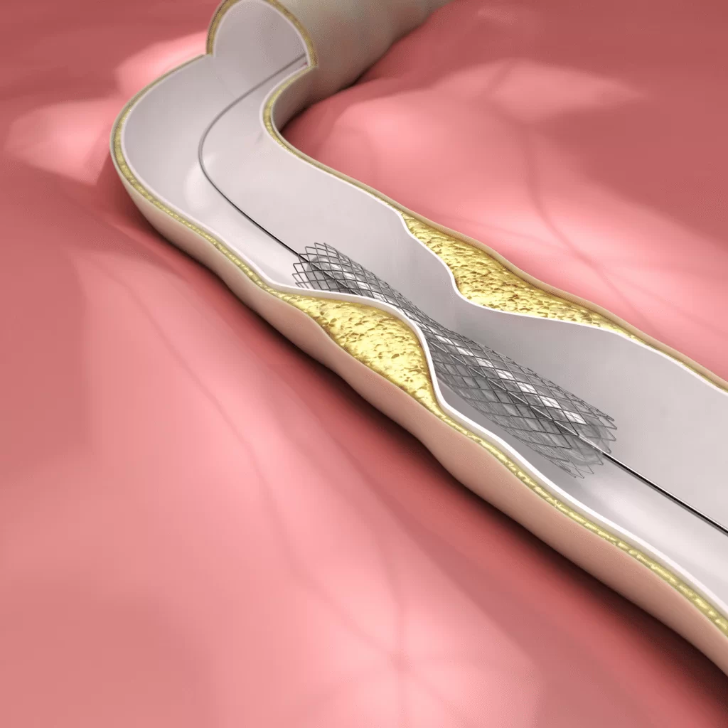 Coronary Angioplasty and Stents in Jaipur