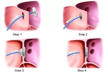 Overview - About Device Closure of ASD/VSD/PDA