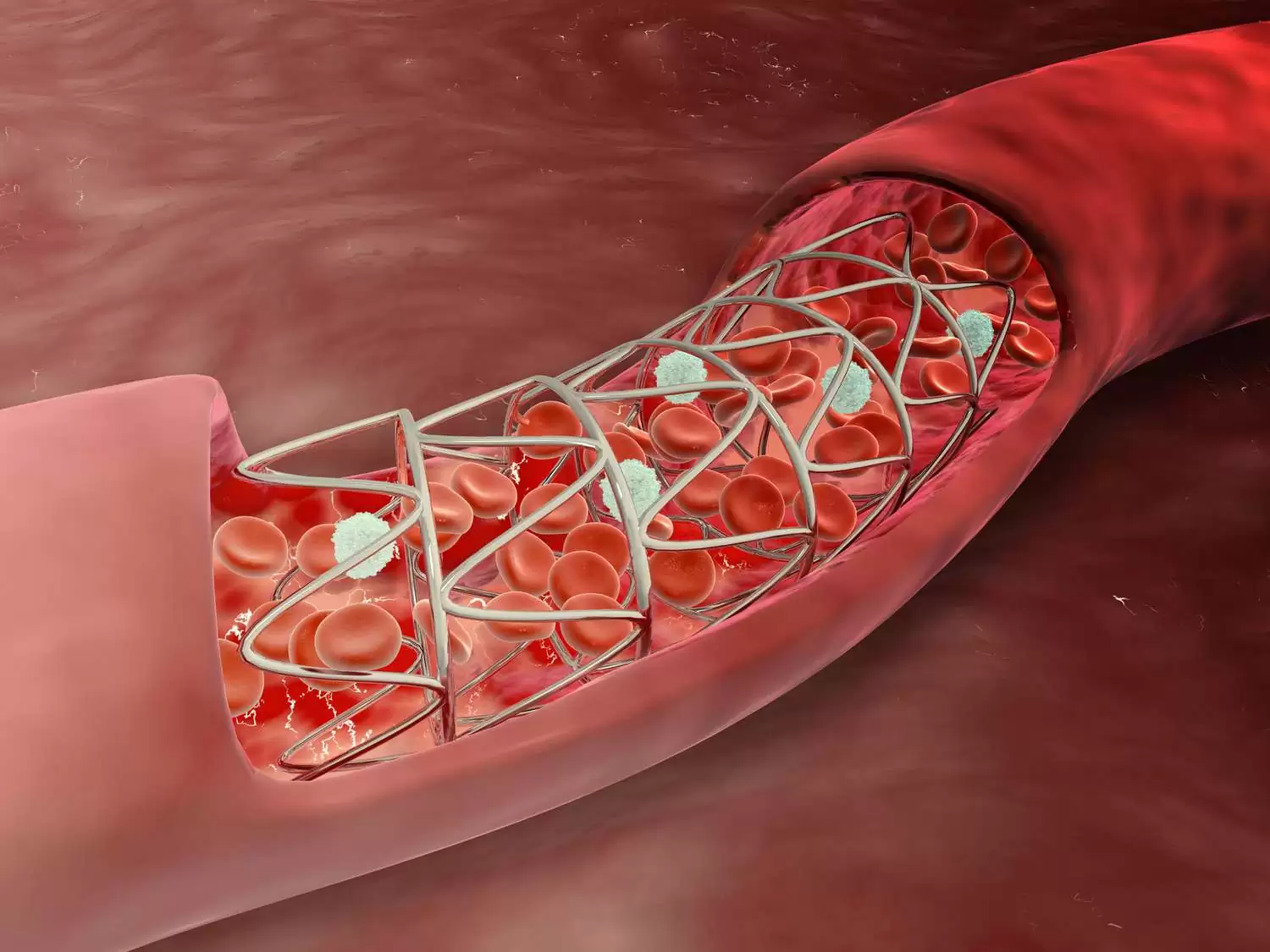 Coronary Angioplasty and Stents in Jaipur