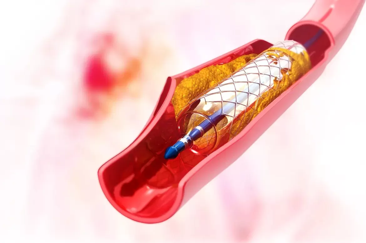 Coronary Angioplasty and Stents in Jaipur