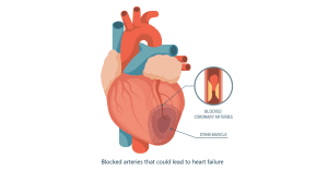 Heart Failure Treatment in Jaipur
