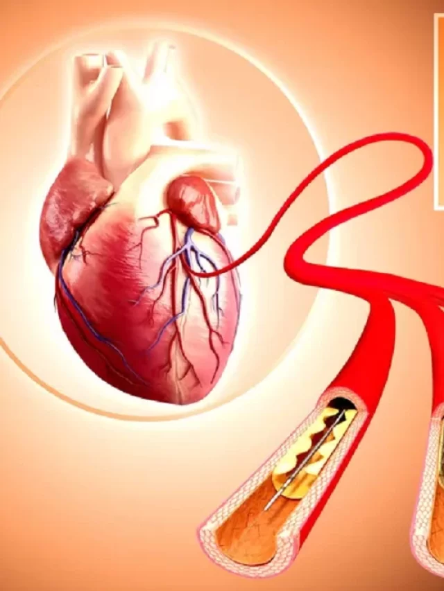 Types of Angioplasty