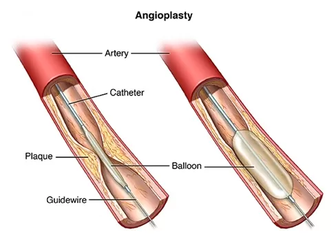 Angioplasty & Stent Placement in Jaipur