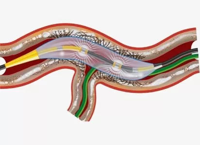 About Intravascular Lithotripsy or IVL