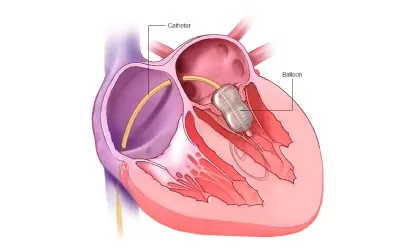 About Valvuloplasty